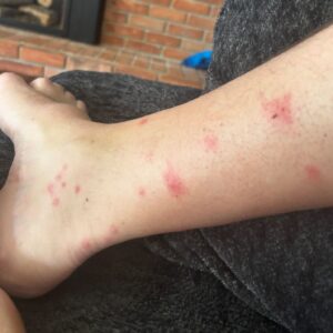 Worst Bites Ever